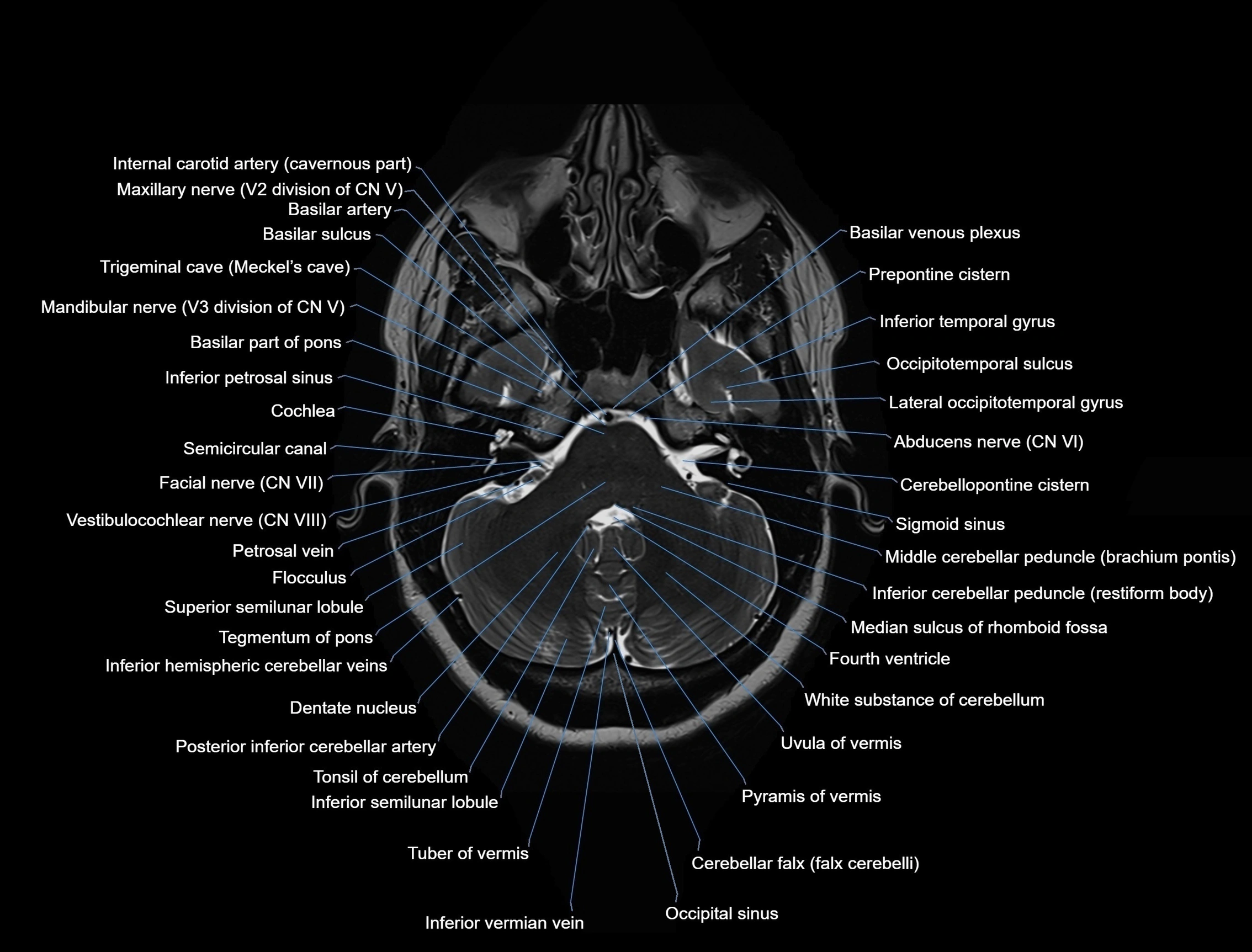 MRI Brain axial cross sectional radiology anatomy 3T image  -img-00001-00013.webp